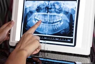 closeup of a patient's dental x-rays