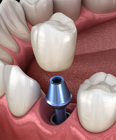 3D render of dental implants at Dr. Jay A. Zimmerman, DMD in Mountainside NJ